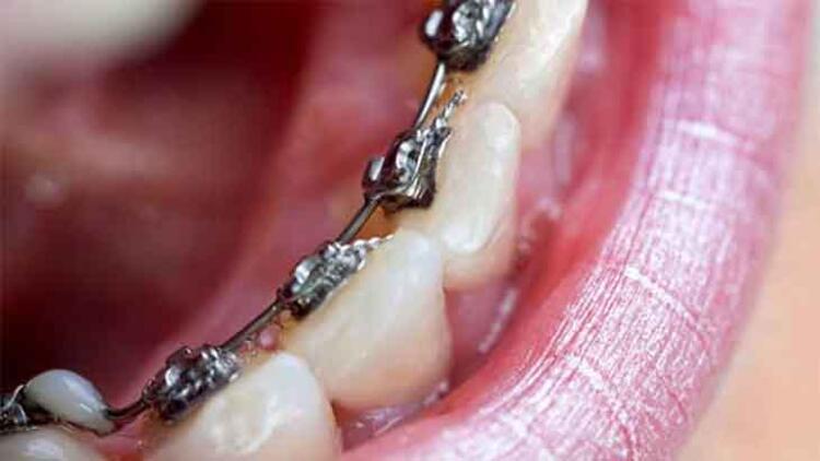 Diş teli leke ve çürüğe neden olur