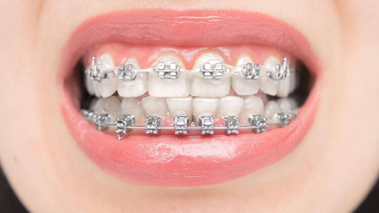 Ortodontik tedavi nedir, ne kadar sürer